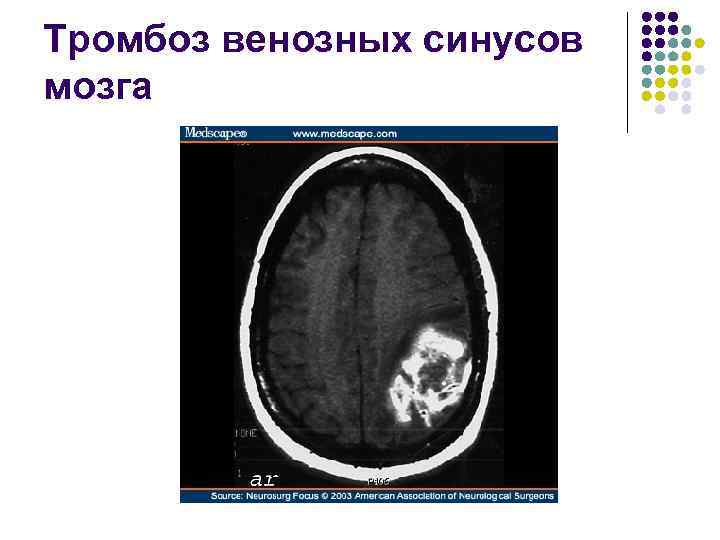 Тромбоз венозных синусов мозга 