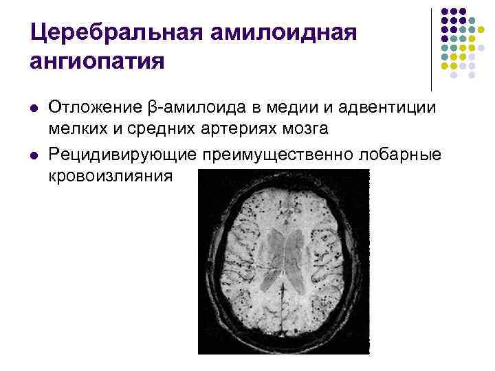Церебральная амилоидная ангиопатия l l Отложение β-амилоида в медии и адвентиции мелких и средних