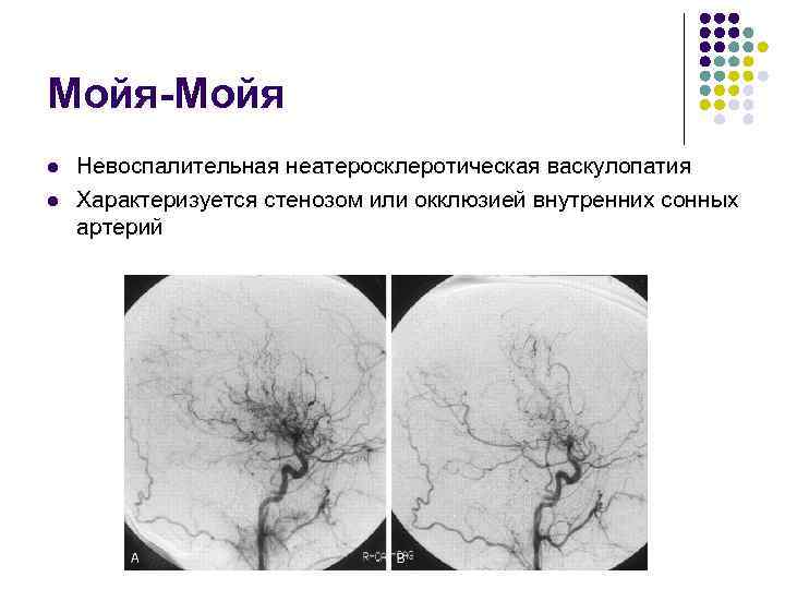 Мойя-Мойя l l Невоспалительная неатеросклеротическая васкулопатия Характеризуется стенозом или окклюзией внутренних сонных артерий 