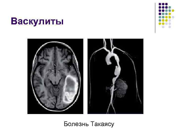 Васкулиты Болезнь Такаясу 