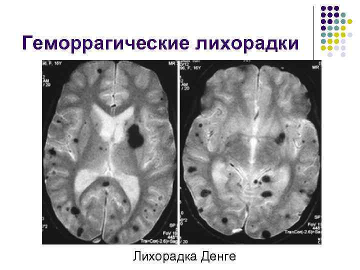 Геморрагические лихорадки Лихорадка Денге 