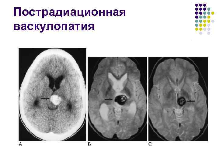 Пострадиационная васкулопатия 