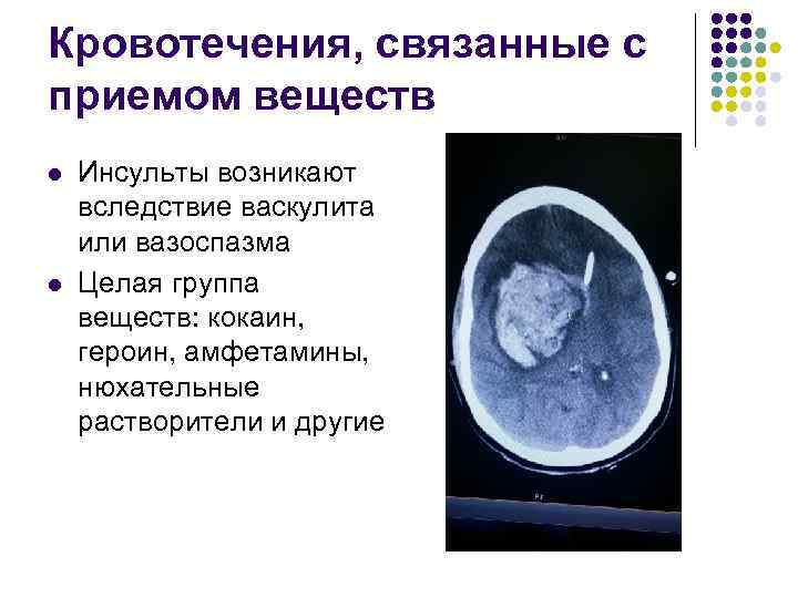 Кровотечения, связанные с приемом веществ l l Инсульты возникают вследствие васкулита или вазоспазма Целая