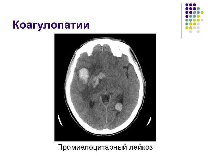 Коагулопатии Промиелоцитарный лейкоз 