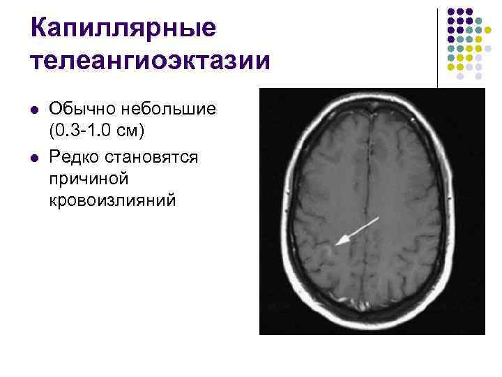 Капиллярные телеангиоэктазии l l Обычно небольшие (0. 3 -1. 0 см) Редко становятся причиной