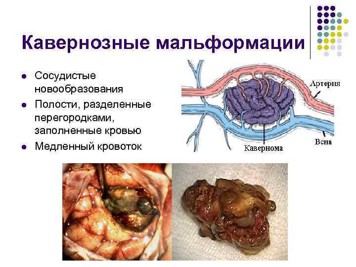 Кавернозные мальформации l l l Сосудистые новообразования Полости, разделенные перегородками, заполненные кровью Медленный кровоток
