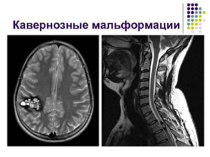 Кавернозные мальформации 