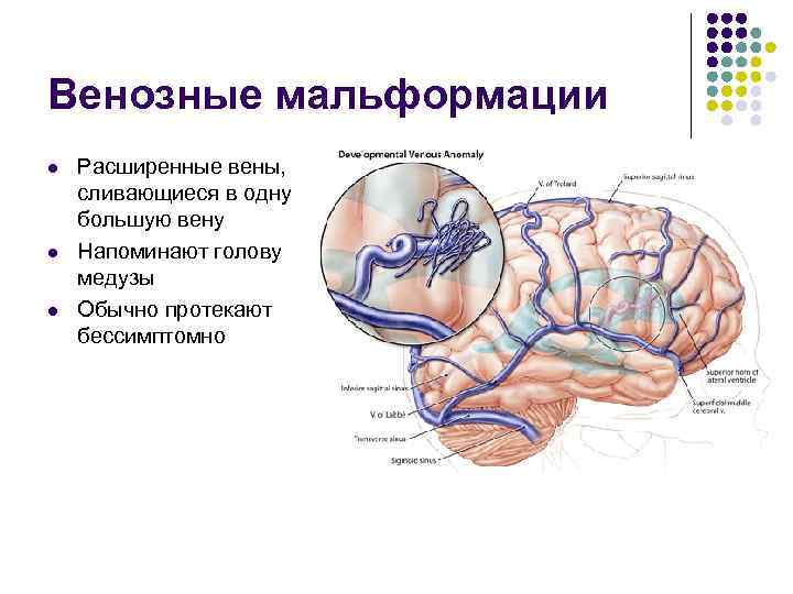 Венозные мальформации l l l Расширенные вены, сливающиеся в одну большую вену Напоминают голову