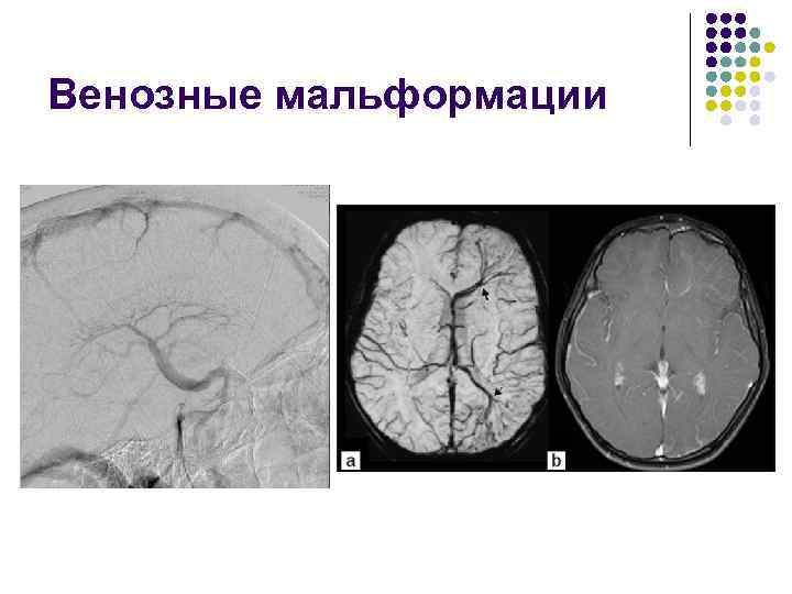 Венозные мальформации 