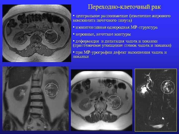 Переходно-клеточный рак • центральное расположение (изменение жирового компонента почечного синуса) • изоинтенсивная однородная МР-структура