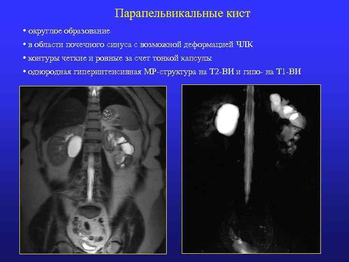 Парапельвикальные кист • округлое образование • в области почечного синуса с возможной деформацией ЧЛК