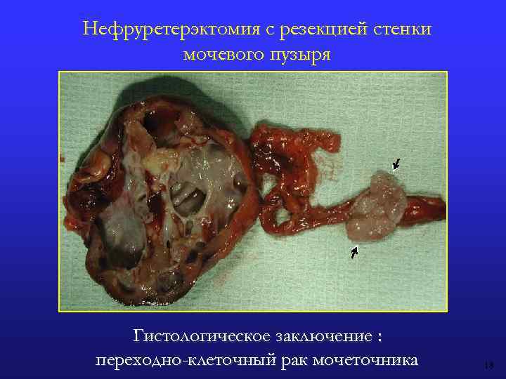 Нефруретерэктомия с резекцией стенки мочевого пузыря Гистологическое заключение : переходно-клеточный рак мочеточника 18 