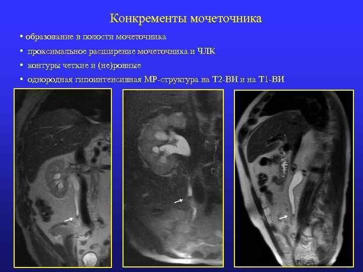 Конкременты мочеточника • образование в полости мочеточника • проксимальное расширение мочеточника и ЧЛК •