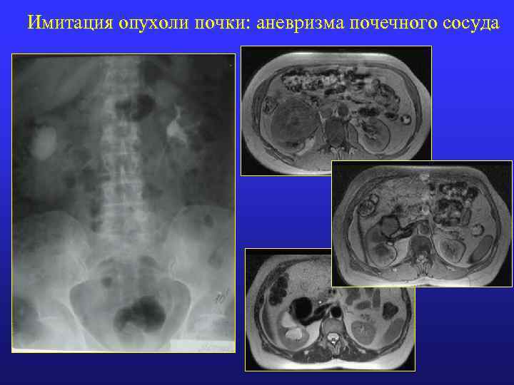 Имитация опухоли почки: аневризма почечного сосуда 