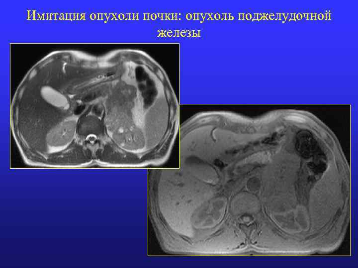 Имитация опухоли почки: опухоль поджелудочной железы 