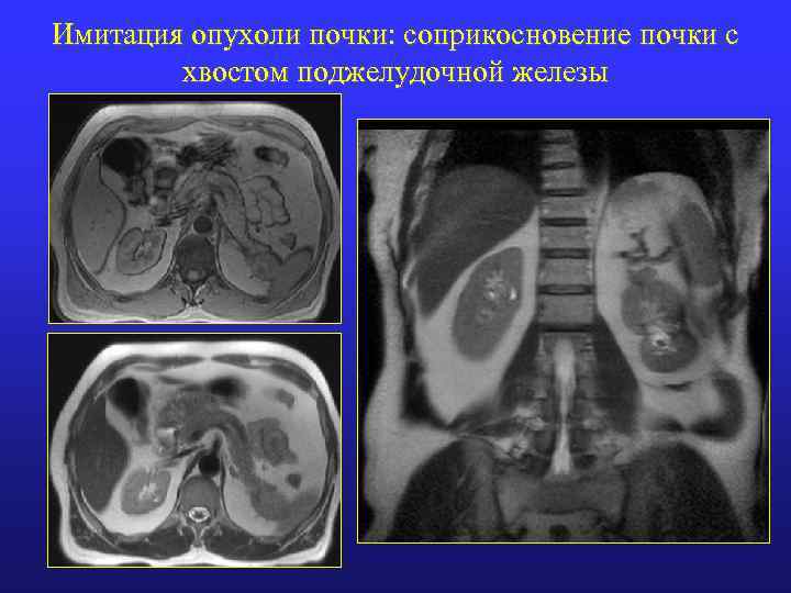 Имитация опухоли почки: соприкосновение почки с хвостом поджелудочной железы 