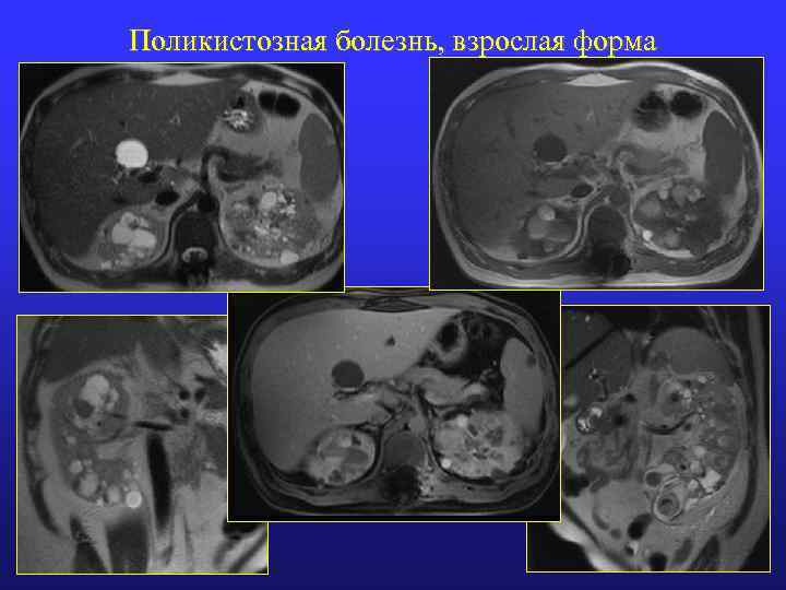 Поликистозная болезнь, взрослая форма 