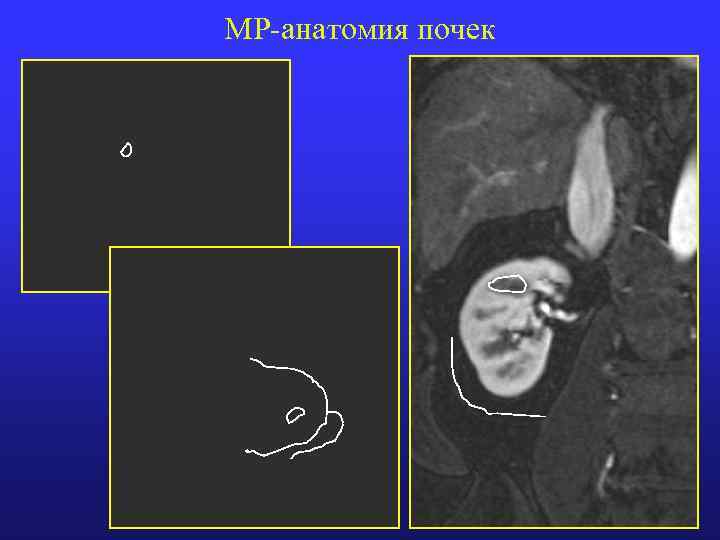 МР-анатомия почек 