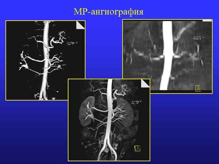 МР-ангиография 