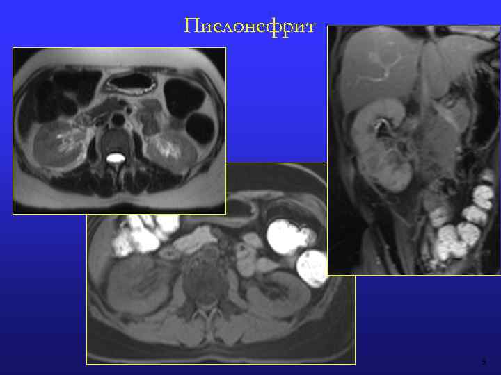 Пиелонефрит 3 