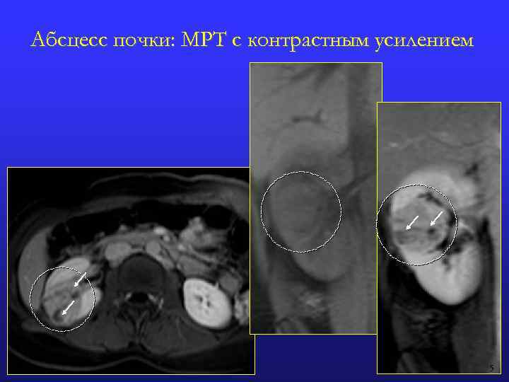 Абсцесс почки фото