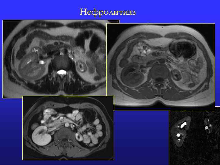 Нефролитиаз 5 