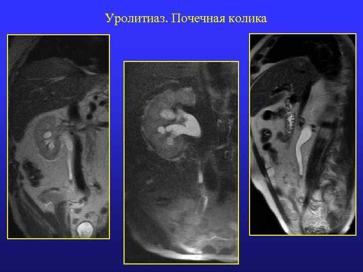 Почечная колика карта вызова 03