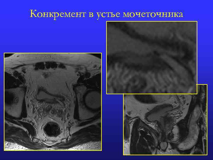 Устье левого мочеточника фото