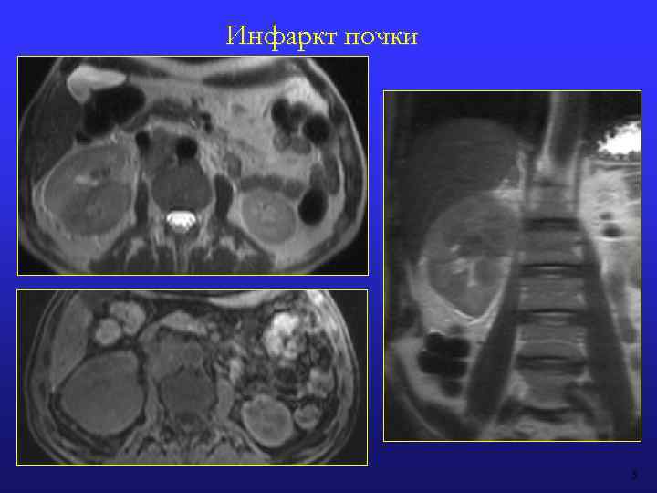 Инфаркт почки 5 