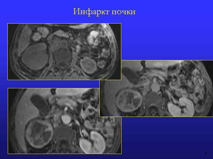 Инфаркт почки 5 