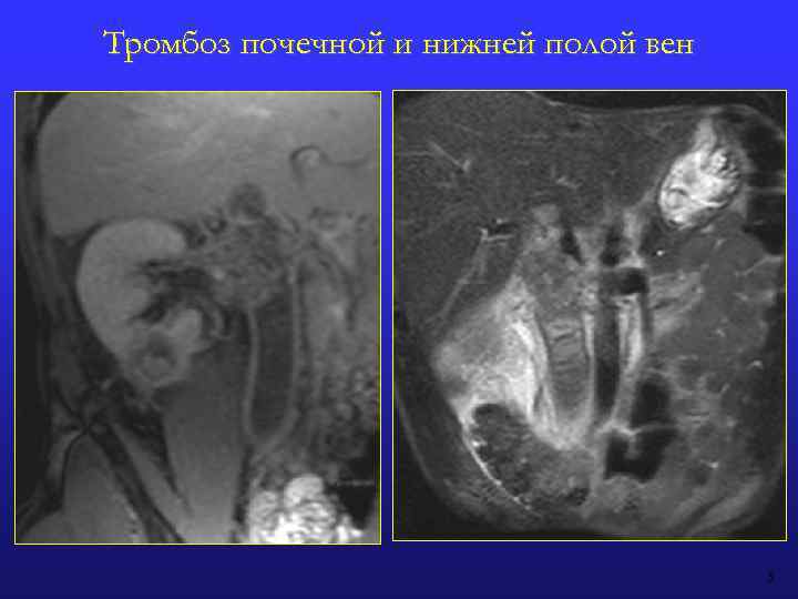 Тромбоз почечной и нижней полой вен 5 