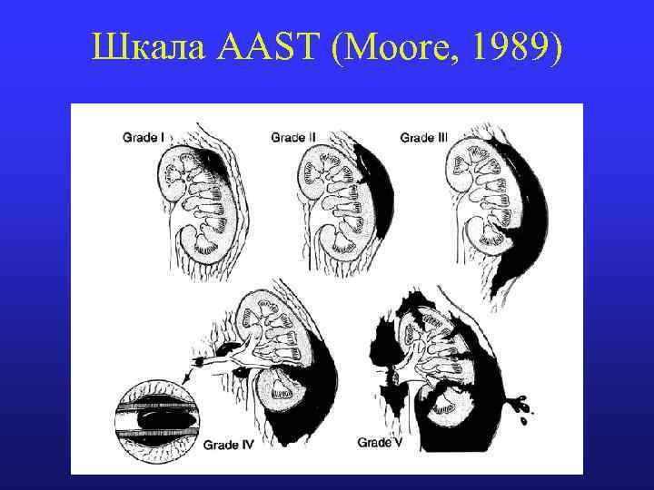 Шкала AAST (Moore, 1989) 