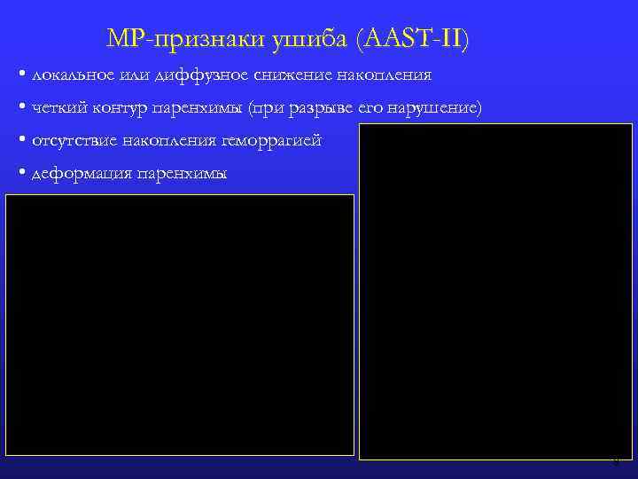 МР-признаки ушиба (AAST-II) • локальное или диффузное снижение накопления • четкий контур паренхимы (при
