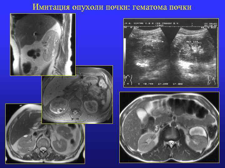 Имитация опухоли почки: гематома почки 