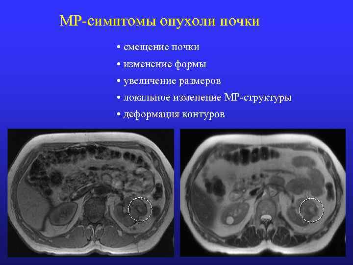 Рак почки симптомы. Опухоль почки мрт признаки.