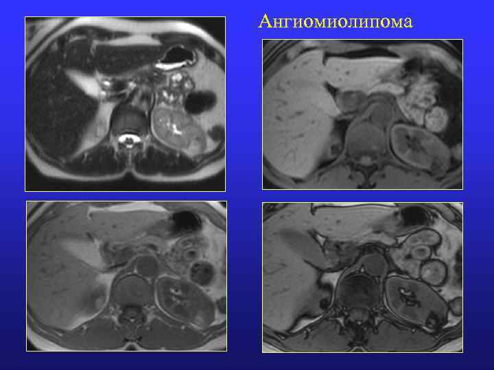 Ангиомиолипома 