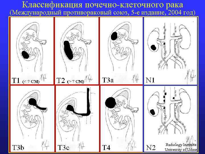 Классификация почечно-клеточного рака (Международный противораковый союз, 5 -е издание, 2004 год) Radiology Institute University