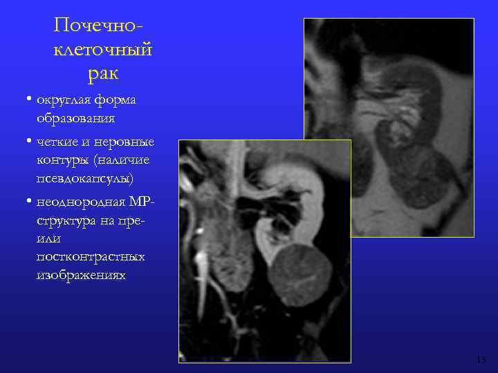 Почечноклеточный рак • округлая форма образования • четкие и неровные контуры (наличие псевдокапсулы) •