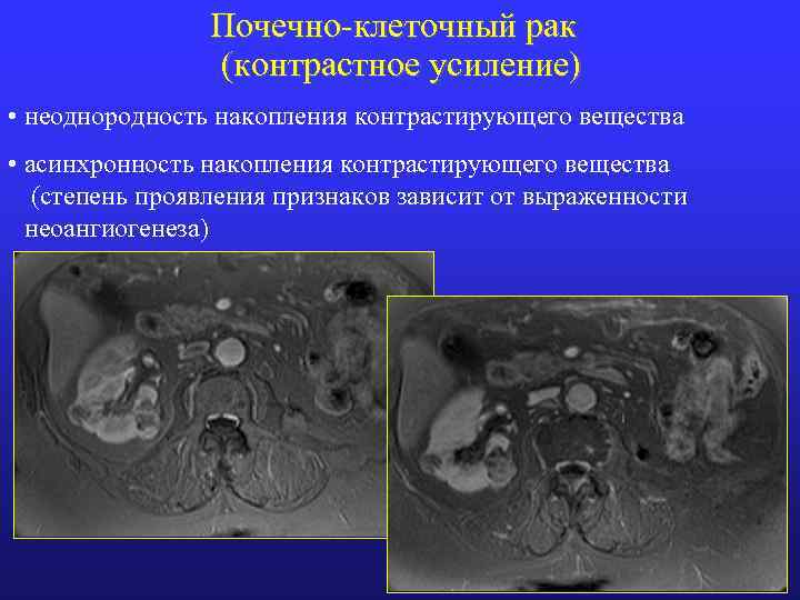 Почечно-клеточный рак (контрастное усиление) • неоднородность накопления контрастирующего вещества • асинхронность накопления контрастирующего вещества