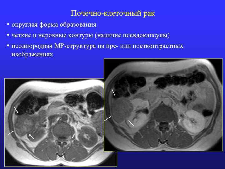 Рак почки метастазы в легких