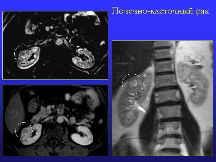 Почечно-клеточный рак 13 