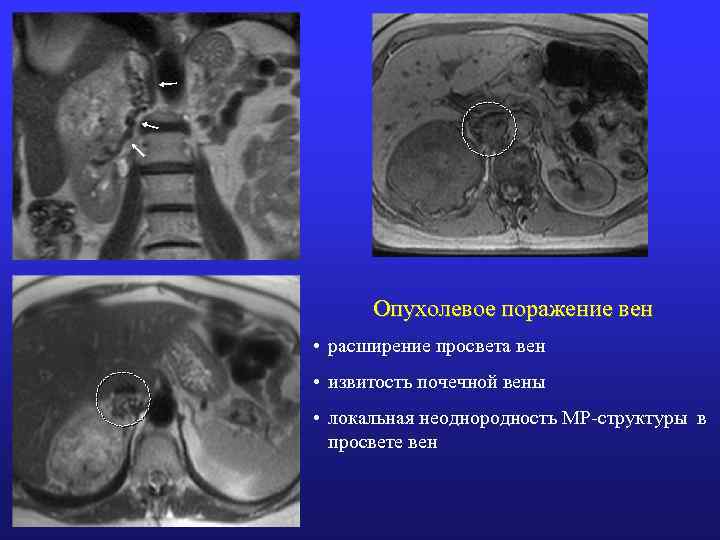 Опухолевое поражение вен • расширение просвета вен • извитость почечной вены • локальная неоднородность