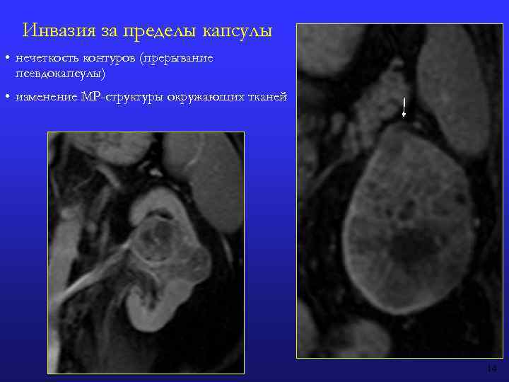 Инвазия за пределы капсулы • нечеткость контуров (прерывание псевдокапсулы) • изменение МР-структуры окружающих тканей