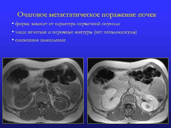 Метастатические поражения печени в ультразвуковом изображении характеризуются