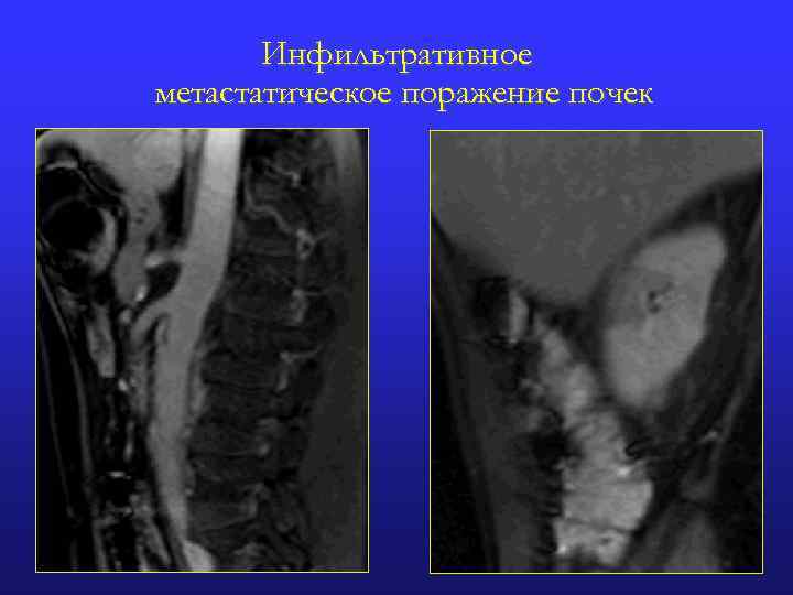 Инфильтративное метастатическое поражение почек 