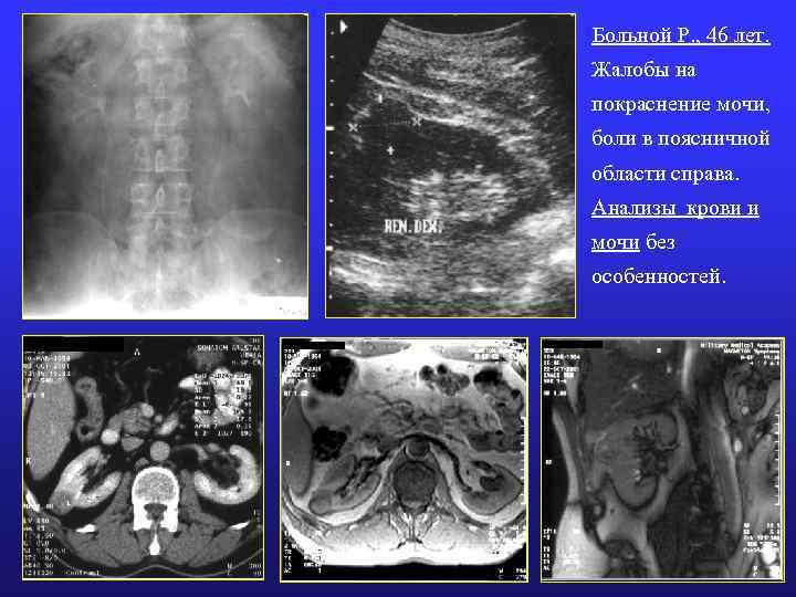 Больной Р. , 46 лет. Жалобы на покраснение мочи, боли в поясничной области справа.