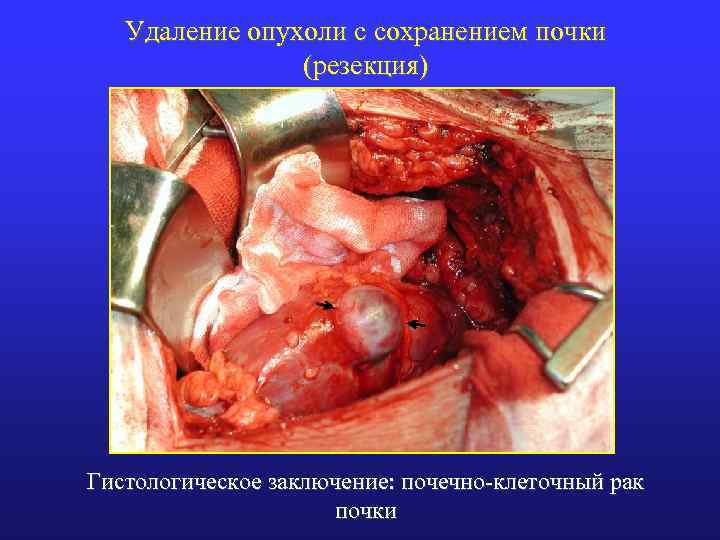 Удаление опухоли с сохранением почки (резекция) Гистологическое заключение: почечно-клеточный рак почки 