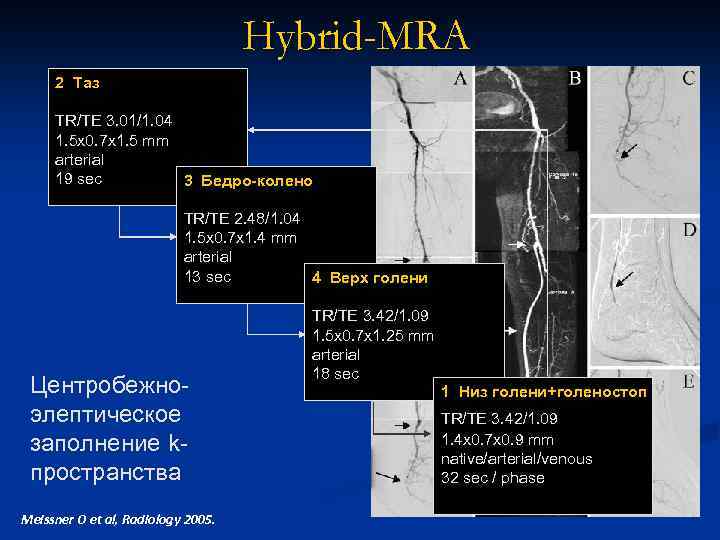 Hybrid-MRA 2 Таз TR/TE 3. 01/1. 04 1. 5 x 0. 7 x 1.