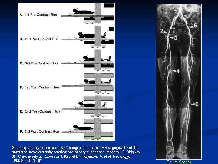 Stepping-table gadolinium-enhanced digital subtraction MR angiography of the aorta and lower extremity arteries: preliminary