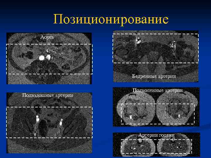 Позиционирование Аорта Бедренные артерии Подвздошные артерии Подколенные артерии Артерии голени 